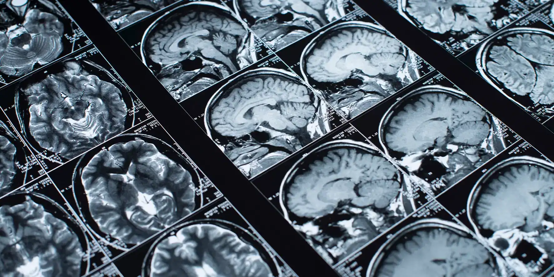 Alzheimer's Stem Cells